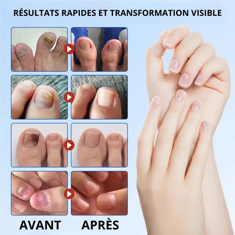 Patchs Ongles Anti-Mycose