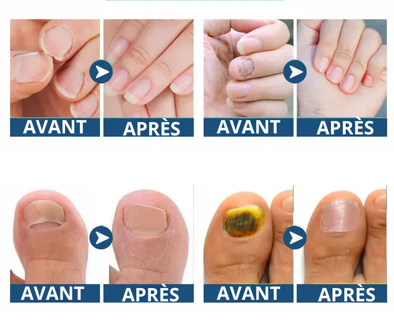 Patchs Ongles Anti-Mycose