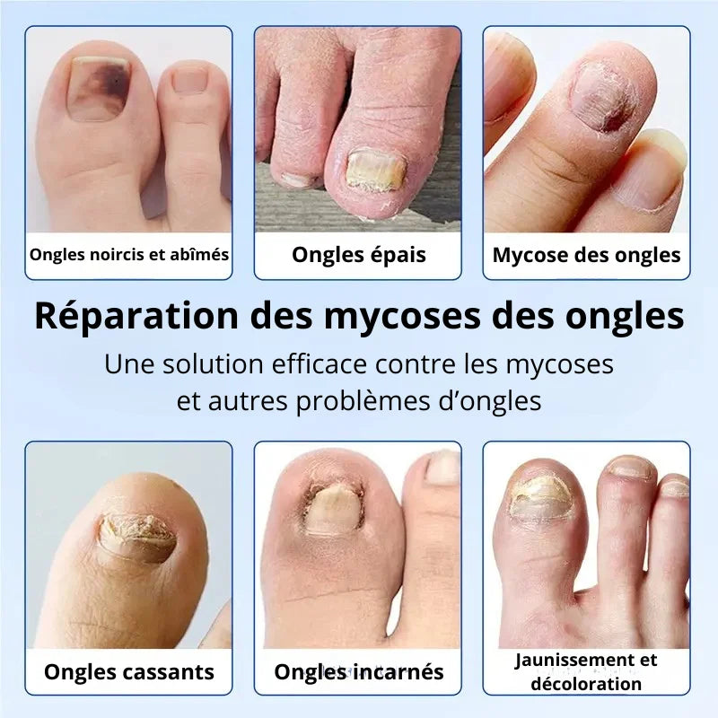 Patchs Ongles Anti-Mycose