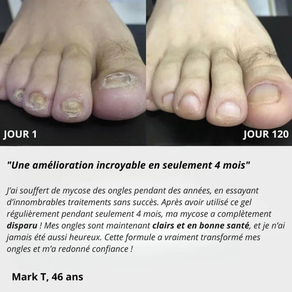 Gel Anti-Mycose Ongles