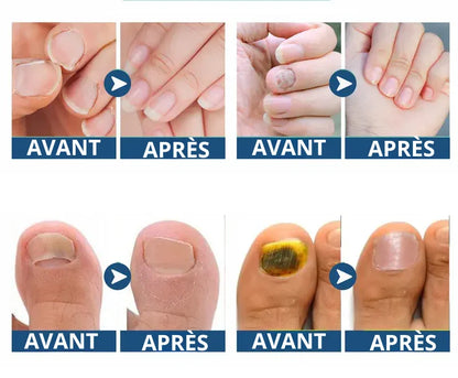 Patchs Ongles Anti-Mycose